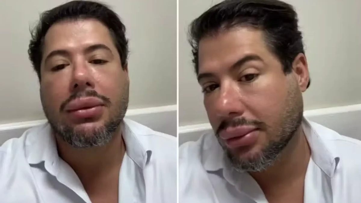 Hugo aparece com rosto e lábios inchados após nova harmonização facial; Veja as fotos